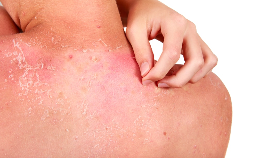 آلوئه ورا برای آفتاب سوختگی