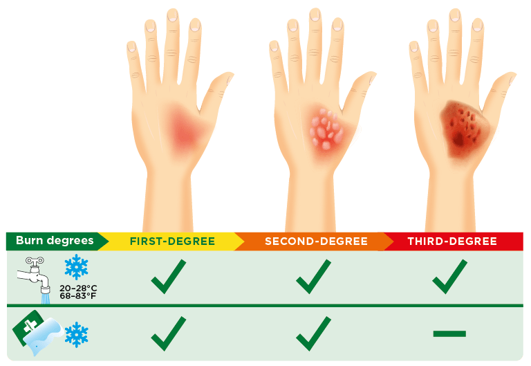 آلوئه ورا برای سوختگی درجه 1