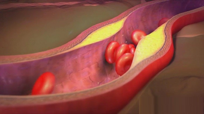 مضرات چربی خون