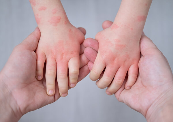 بیماری اگزما