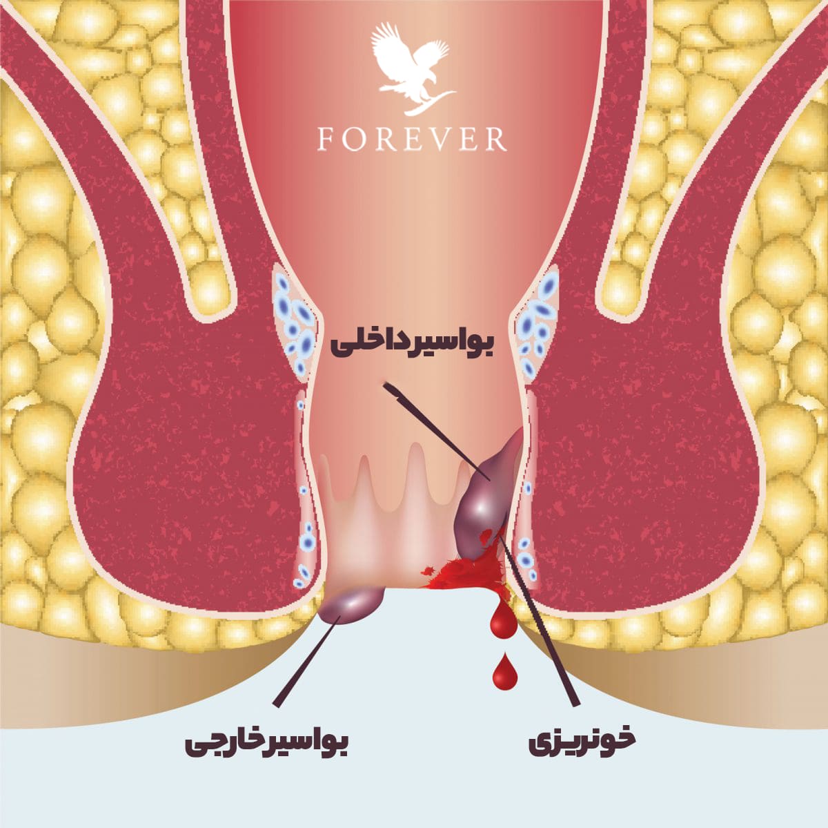 بواسیر یا هموروئید