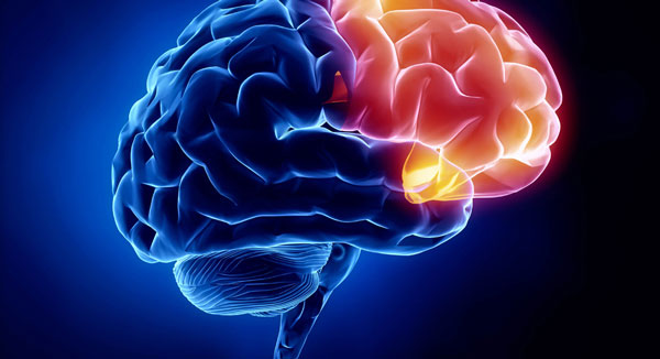 درمان سکته ی مغزی