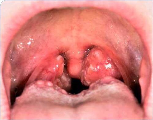 ورم لوزه چیست