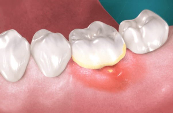 درمان آبسه لثه (پریودنتال) چگونه است؟